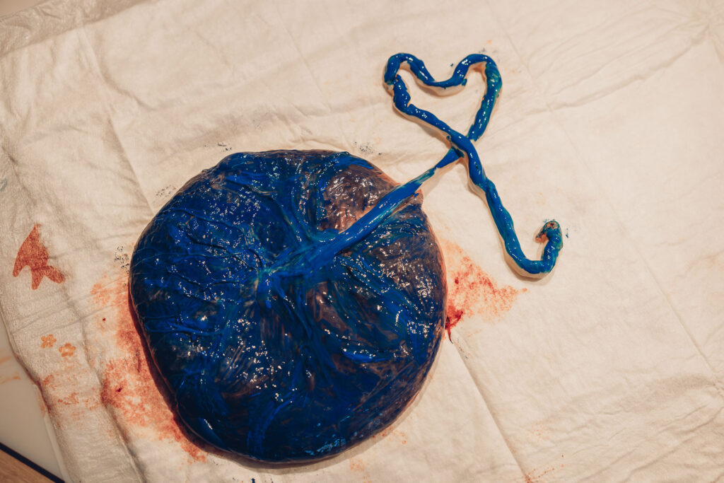 Plazentaabdruck nach Hausgeburt im Saarland